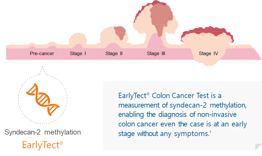 A diagram shows colon cancer progression from pre cancer to stage IV, with increasing tumour size. Text describes EarlyTect, a non invasive stool DNA test for colorectal cancer screening that detects syndecan 2 methylation, even in asymptomatic cases.